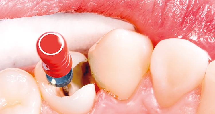 Reabsorción dentinaria interna en un incisivo lateral superior 