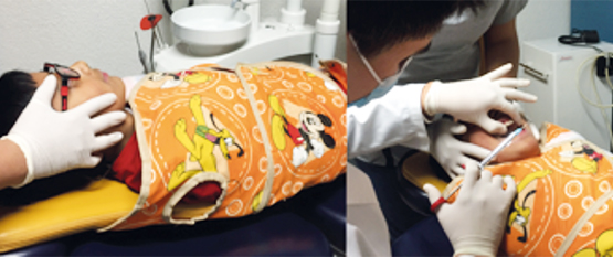 Figura 8. Técnica de estabilización por protección con el uso de un Papoose Board. Nótese cómo se cubre el rostro del paciente con una mano para evitar que el niño vea la aguja de anestesia.