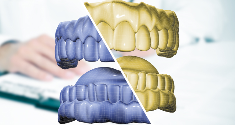 Asimetría mandibular con mordida cruzada posterior unilateral derecha
