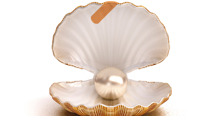 Camuflaje clase III en paciente con labio y paladar hendido, mordida abierta anterior 