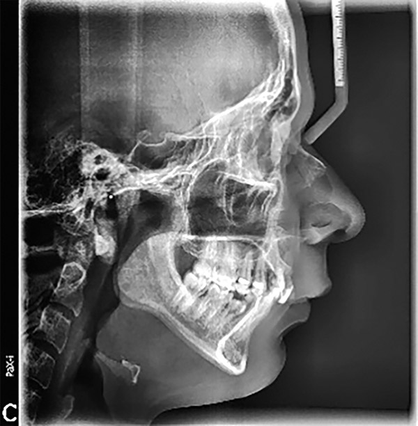 Figura 1. Radiografía lateral de cráneo. 