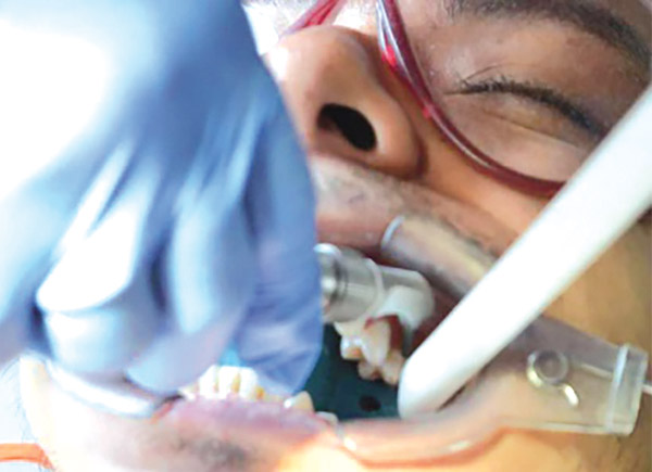 Figura 10. Arenado de la superficie. 