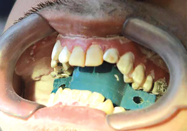 Figura 11. Arenado terminado. 