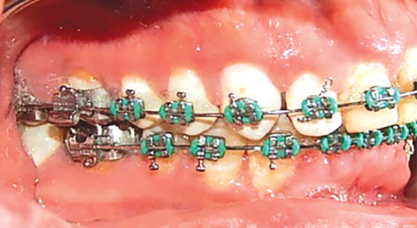 Figura 12. Intraoral derecha. 