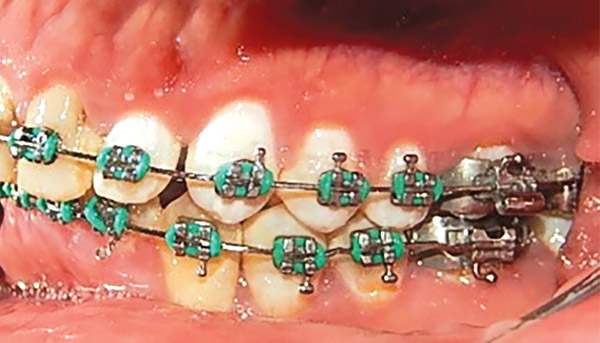 Figura 14. Izquierda. 
