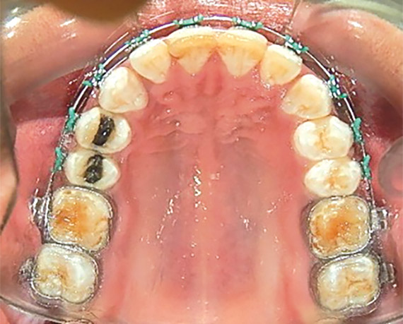 Figura 15. Oclusal superior. 