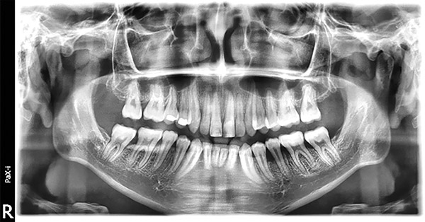 Figura 24. Rx. panorámica. 