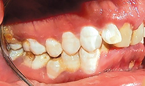 Figura 3. Intraoral derecha. 