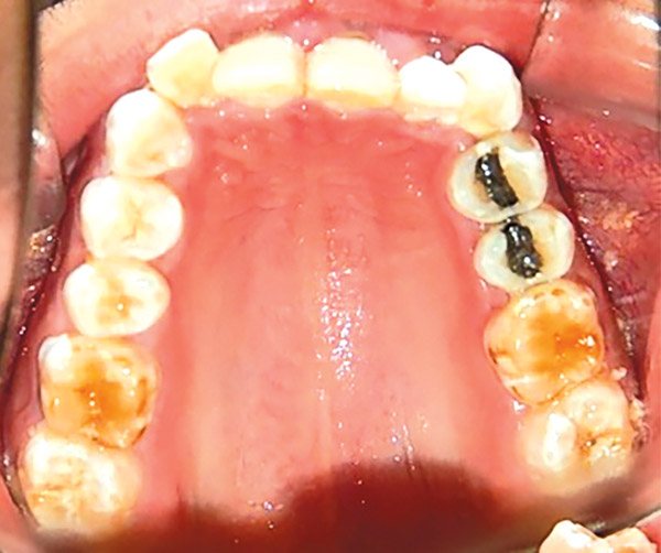 Figura 6. Oclusal superior. 