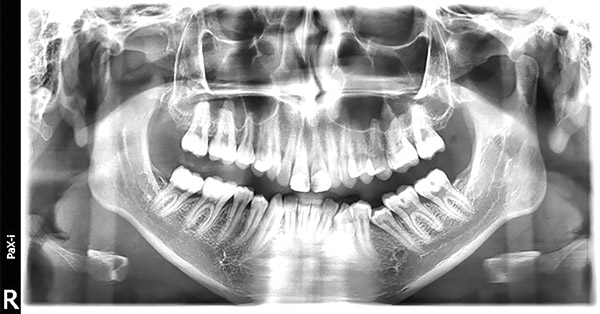 Figura 8. Radiografía panorámica. 