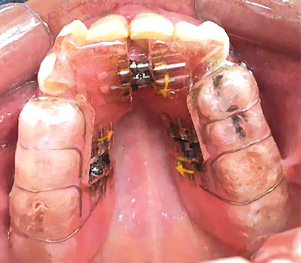 Figura 9. Aparato expansor. 