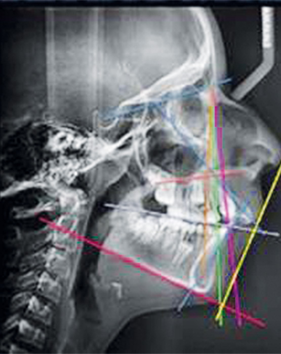 Figura 9. Radiografía lateral de cráneo.