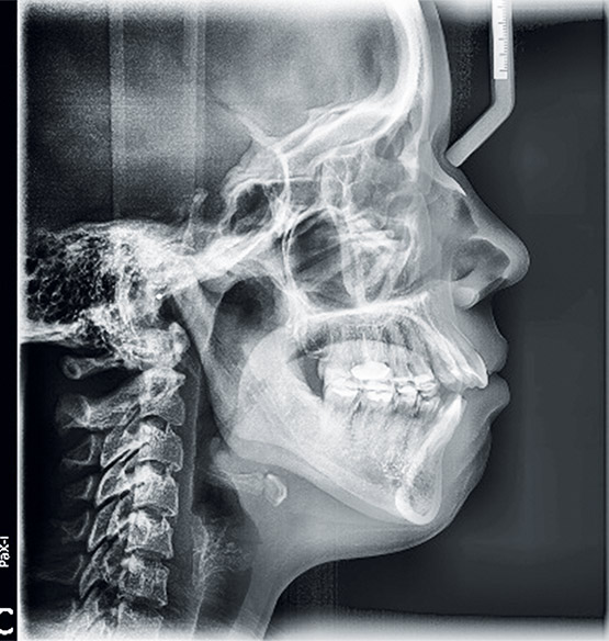 Figura 1. Radiografía lateral de cráneo de inicio.