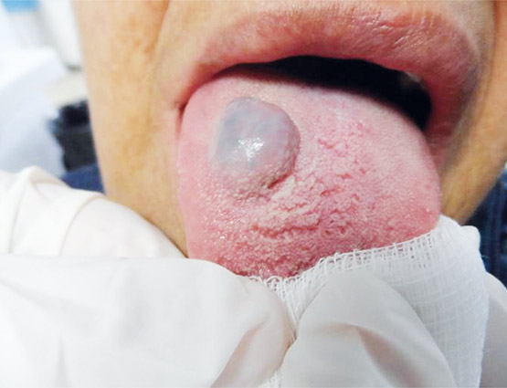 Figura 1. Características clínicas iniciales del hemangioma.
