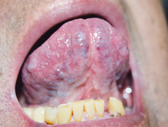Figura 11. Características clínicas del hemangioma al término de la escleroterapia.  