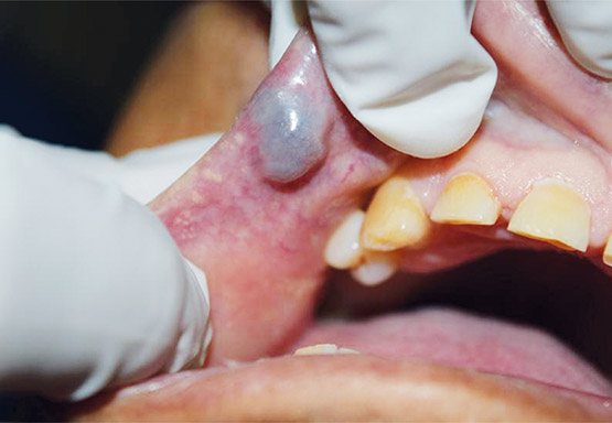 Figura 12. Fotografía clínica inicial del hemangioma.