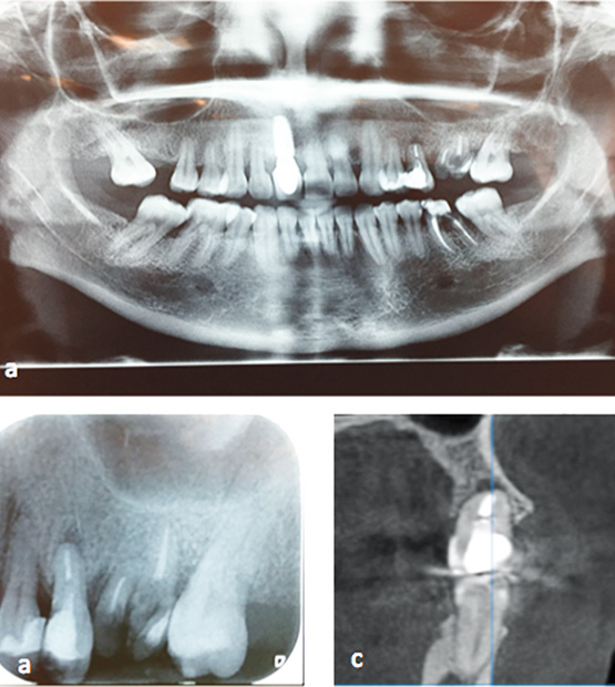 Figura 2. A) Radiografía panorámica. B) Rx Periapical de la zona y C) vista coronal de la tomografía.