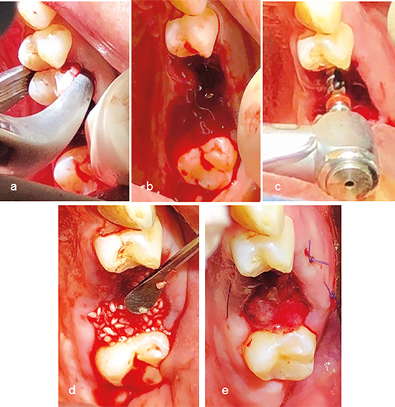 Figura 3. A) exodoncia del 25. B) Alvéolos luego de la colocación de metronidazol y abundante irrigación en zona de 25. C) Osteotomía para la colocación de implante. D) Colocación del aloinjerto para rellenar el gap en 25 y preservación de alveolo en 26. E) Colocación de membrana colágeno y sutura.