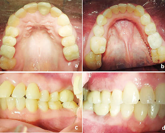 Figura 4. Vista superior e inferior en donde se aprecian las coronas definitivas en zirconia