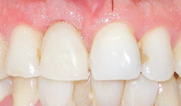 Figura 15. Situación clínica del provisional donde se observa buena armonía en los tejidos periodontales. 