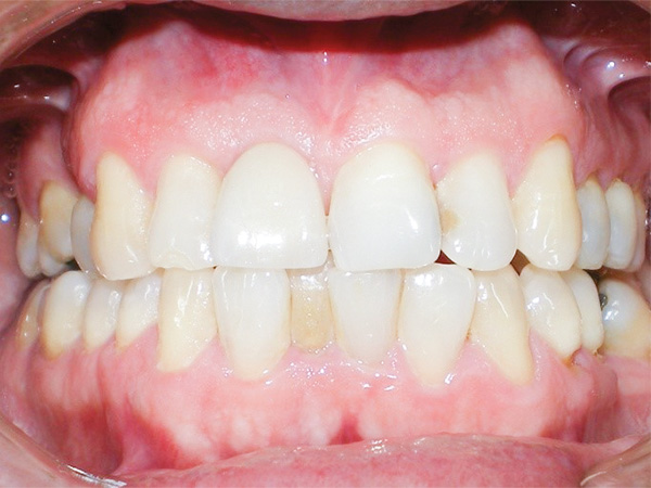 Figura 18. Situación clínica de la corona definitiva en sitio 11, se observa una buena adaptación de los tejidos periodontales y correcto llenado de espacios interproximales. 