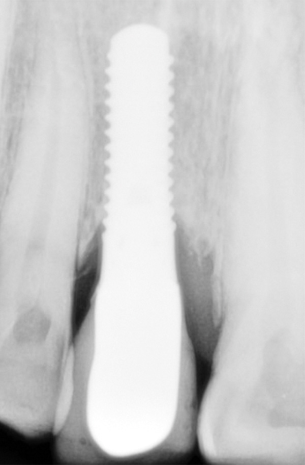 Figura 19. En la radiografía periapical se observa una integración correcta y buen nivel óseo en toda la periferia del implante. 