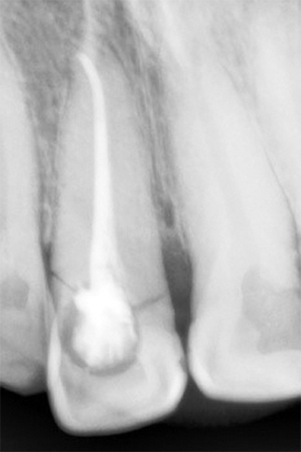 Figura 2. La radiografía periapical nos muestra la fractura de la corona. 