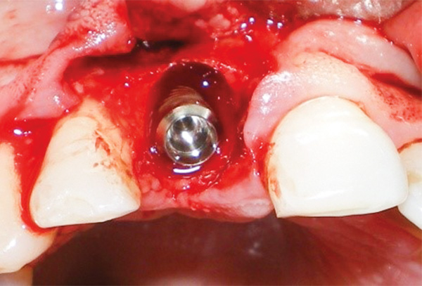 Figura 3. Implante TE Regular Neck colocado en el alveolo. 