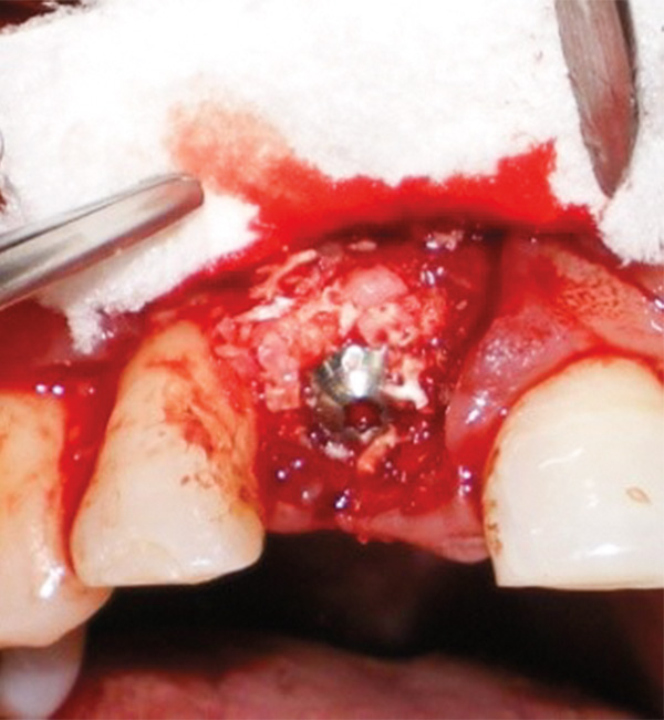 Figura 8. Vista bucal después de la colocación del injerto óseo autólogo. 