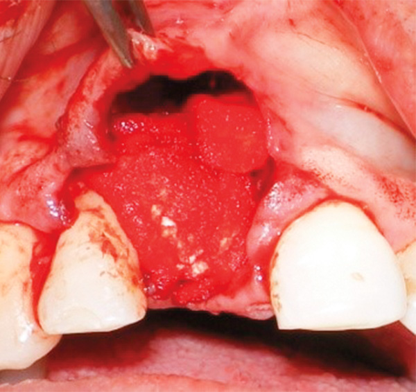 Figura 9. Vista bucal donde se muestra la membrana de colágeno colocada sobre el injerto óseo. 