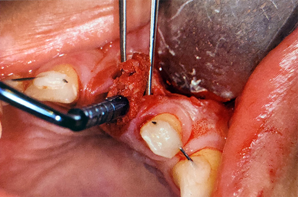 Figura 3. Los espacios entre el implante y las paredes del hueso alveolar se rellenan con hueso gomoso antes de cerrar el sitio. 