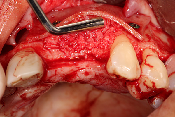 Figura 6. El hueso gomoso es colocado entre la superficie bucal de la cresta y la lámina ósea para aumentar horizontalmente la cresta para permitir la colocación del implante después de la remodelación. 