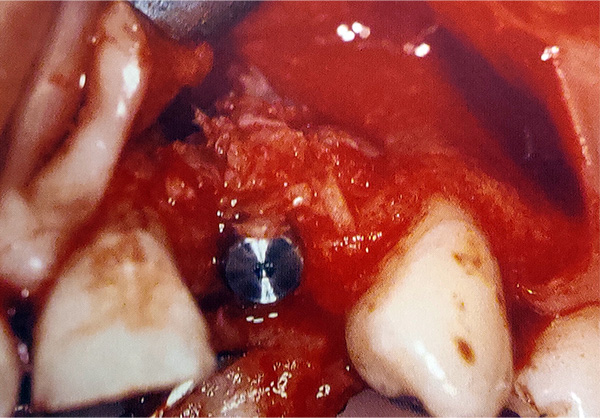 Figura 7. El hueso gomoso se coloca sobre las roscas del implante expuestas durante la inserción del implante que permitirá al injerto óseo permanecer donde se necesite a medida que el hueso cicatriza y previene la dispersión del mismo. 