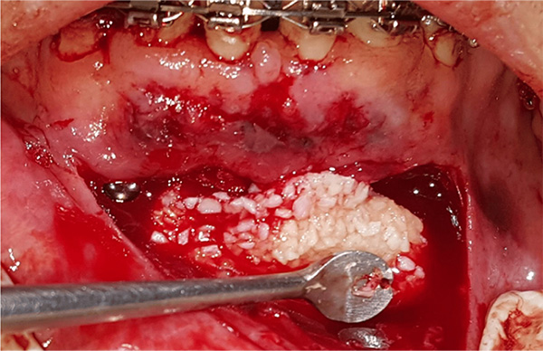 Figura 9. El hueso gomoso se coloca para rellenar un defecto en la parte anterior de la mandíbula, apical a los dientes existentes. 