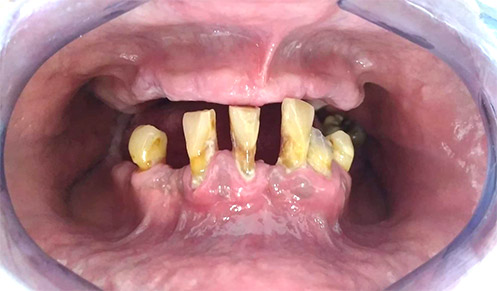 Figura 1. Periodontitis tipo 3 (severa) con grado de progresión IV. Una enfermedad periodontal que no se diagnostica y trata a tiempo puede evolucionar hasta la movilidad y pérdida dental