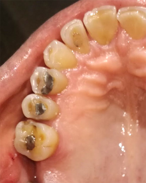 Figura 2. La atrición dental comienza dañando el esmalte y/o las restauraciones, si no se trata a tiempo puede continuar hasta dentina y progresivamente puede llegar a una pulpitis irreversible.