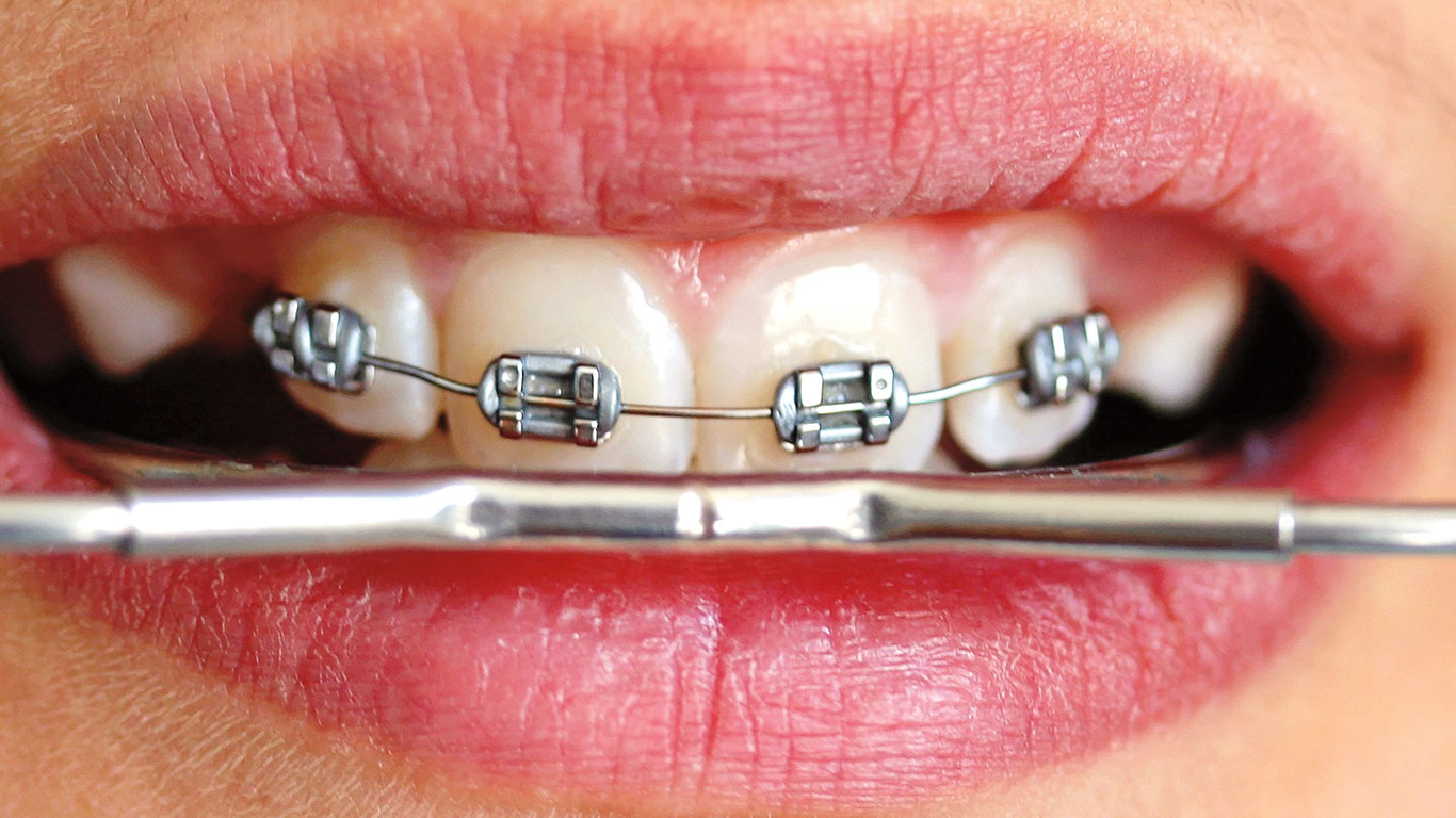 Necesidad de tratamiento ortodóntico según el índice IOTN en modelos de estudio  