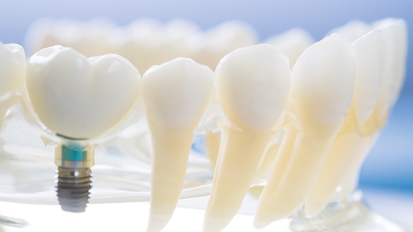Colocación de implante inmediato postextracción en alveolo con lesión periapical 