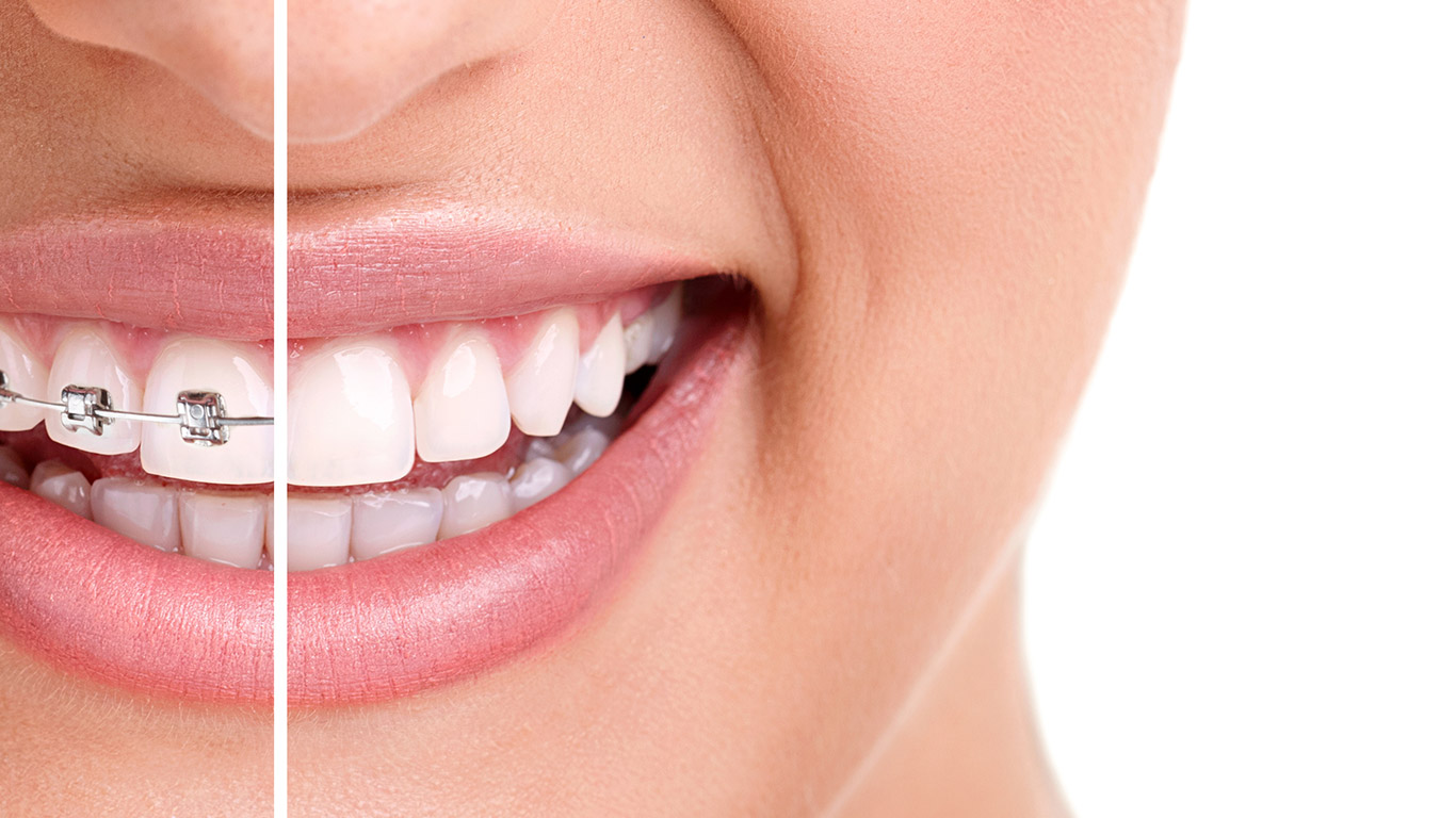 Verticalización de segundos molares con alambre de nickel titatium, caso clínico 