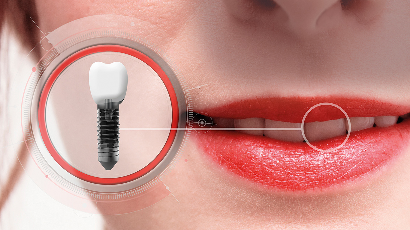 Factores de riesgo que favorecen el desplazamiento del implante dental al seno maxilar 