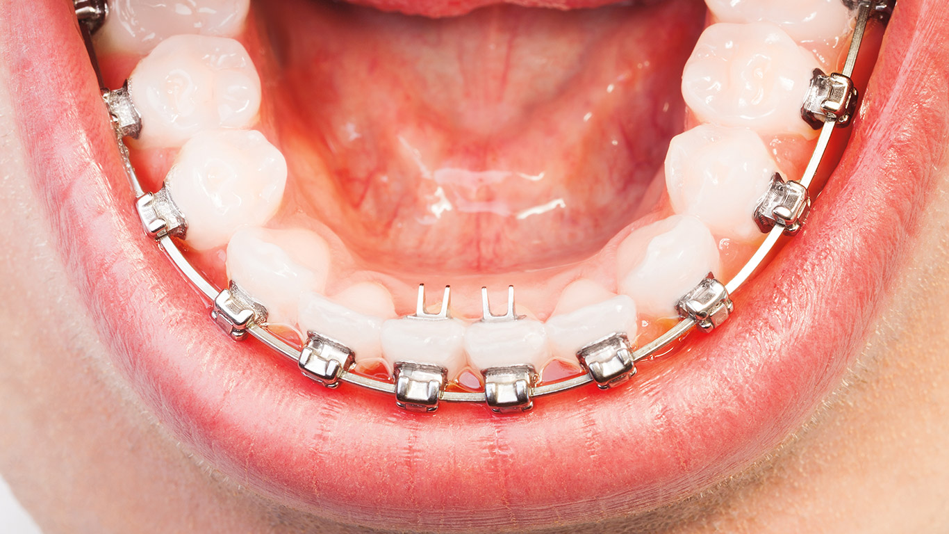 Manejo ortodóntico de paciente comprometido periodontalmente 