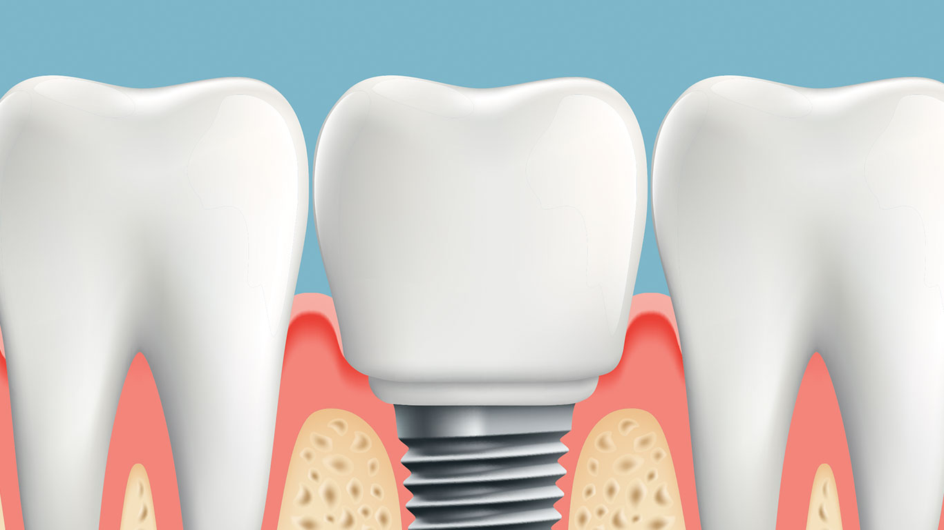 Fundamentos para el uso de implantes dentales cortos  