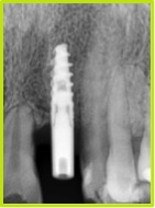 Rx postoperatoria 2 meses de evolución, se aprecia totalmente osteointegrado el implante.