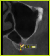 Caso 2. Tomografía corte coronal se aprecia la poca altura de la cresta ósea al piso del seno maxilar de 5.4.