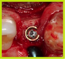 Implante de 3.0×10 mm, en una cresta de 2 mm, libre de dehiscencias de las cuerdas del implante.