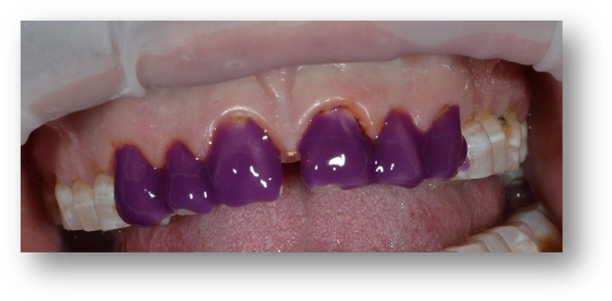 Figura 16. Grabado del esmalte dental con ácido fosforico