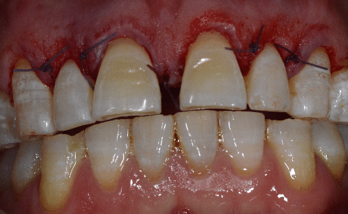 Figura 5. Gingivoplastía y gingivectomía.