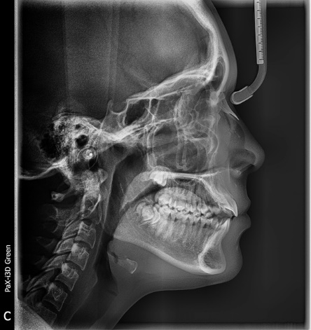 Figura 4. Radiografía lateral de cráneo inicio.