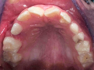 Figura 2. Fotografía clínica vista de la superficie palatina. Se puede observar el talón cuspídeo unilateral presente en la pieza 22.