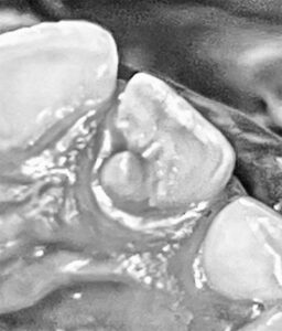 Figura 3. Fotografía clínica detalle. Se aprecia la forma triangular y cómo el vértice cuspídeo se adosa a la superficie palatina en el tercio medio.